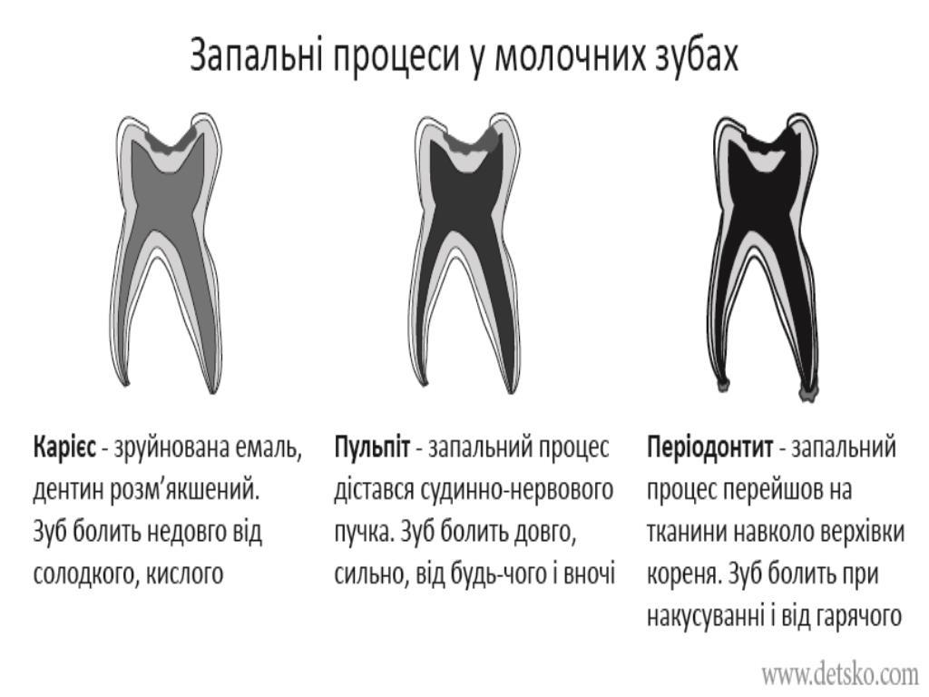 Запальні процеси у молочних зубах